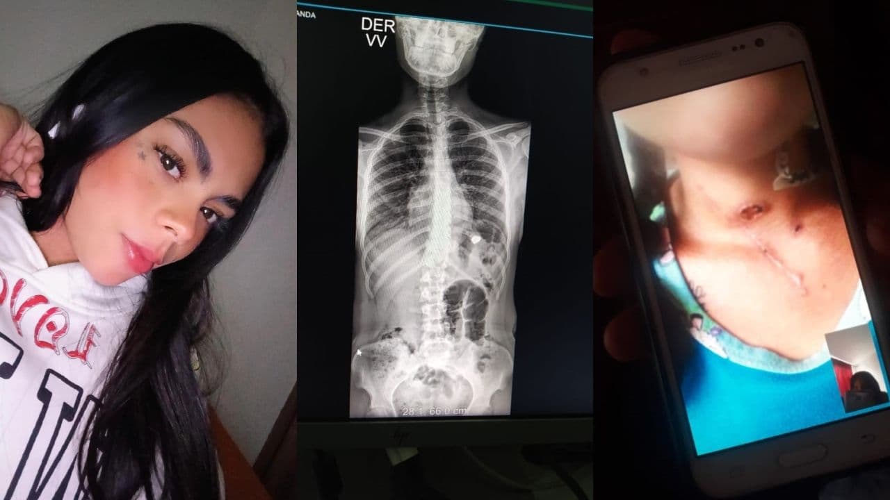 Mujer con bala en un pulmón