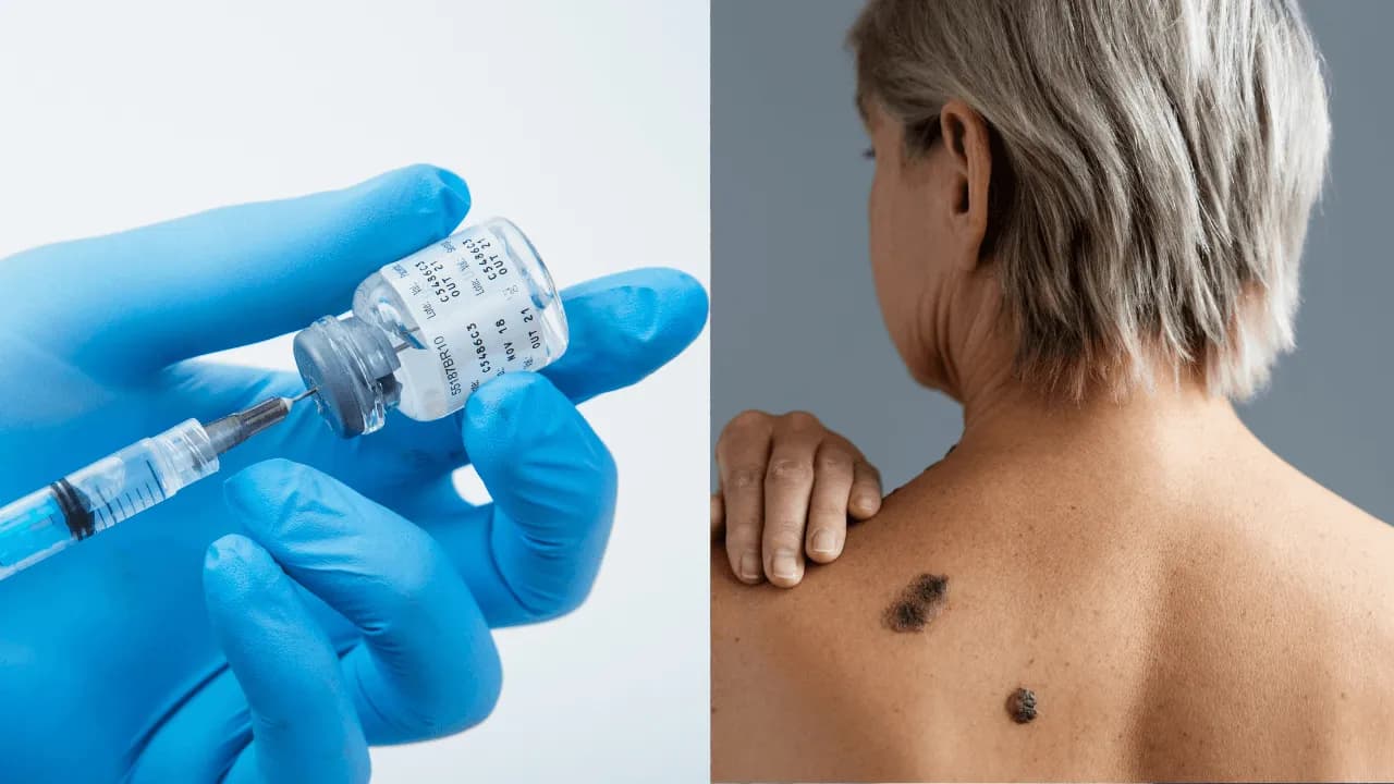Una vacuna personalizada contra el melanoma supera una prueba clave en fase III: claves del esperanzador avance médico