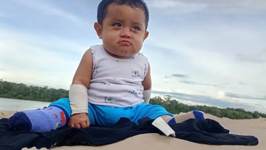 La CIDH exige garantizar el tratamiento de Elián, el bebé indígena con piel de mariposa en Guainía