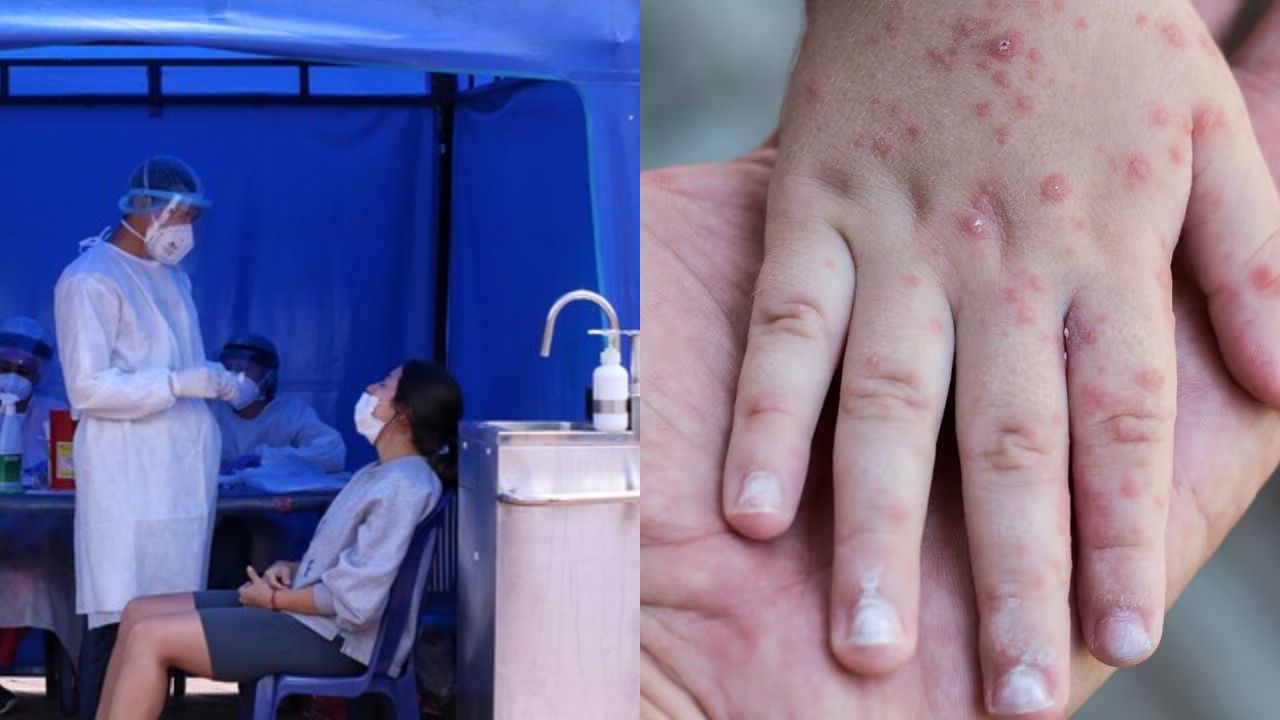 La enfermedad afecta principalmente a niños pequeños entre 5 y 7 años | Crédito: Colprensa